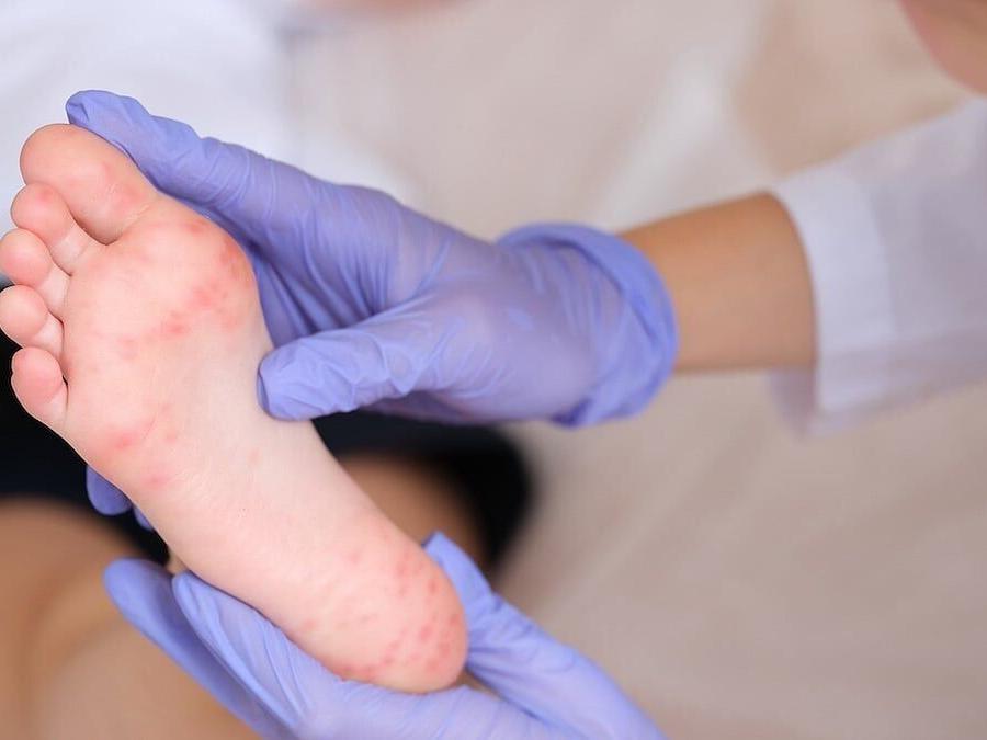 Measles Outbreak Spreads Beyond Utah-Arizona Border, 123 Cases Reported